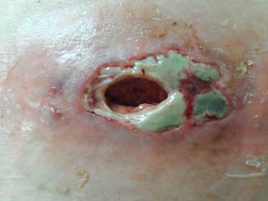 Insulin pump abdominal wound with infection before treatment
