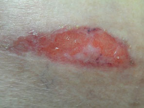 Insulin pump abdominal wound with infection after treatment